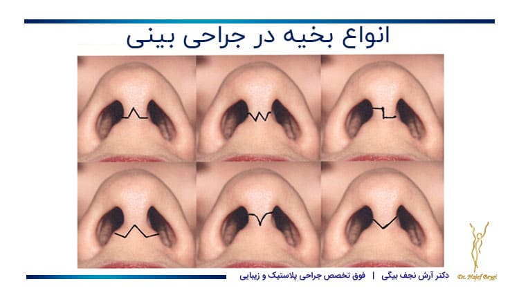 انواع بخیه ها در هنگام انجام جراحی بینی