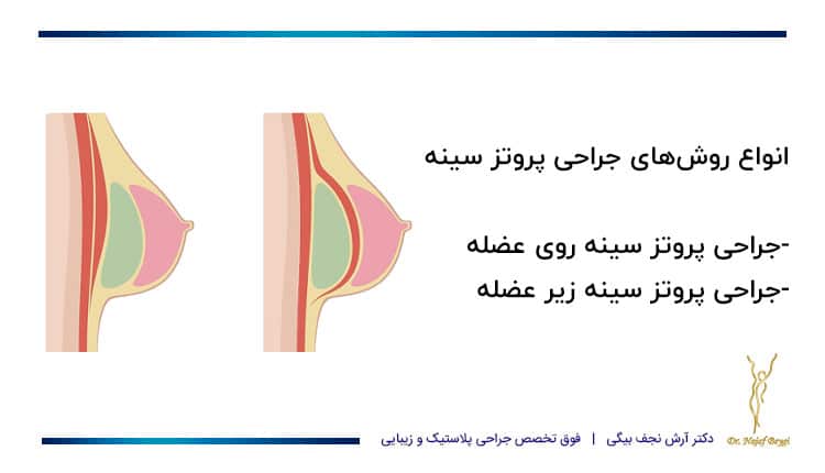 انواع روش‌های جراحی پروتز سینه