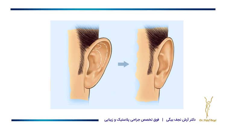 نتیجه بعد از جراحی گوش