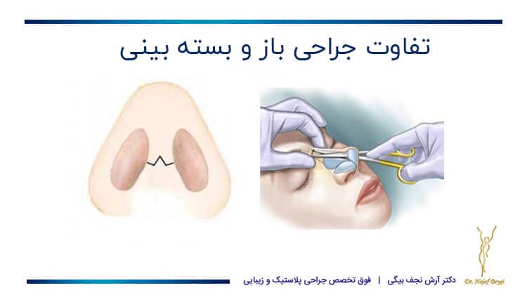 تفاوت انجام جراحی باز و بسته