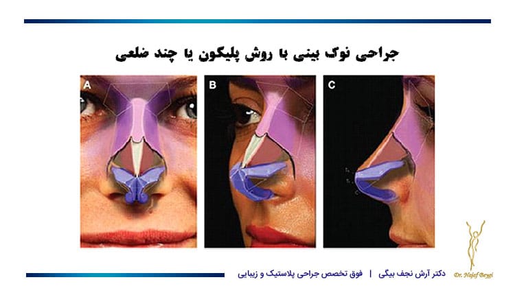 جراحی نوک بینی با روش پلیگون یا چند ضلعی