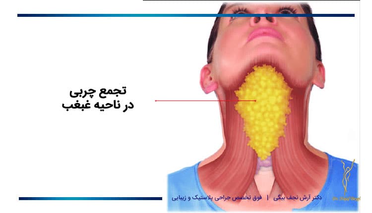 خالی کردن غبغب چگونه است