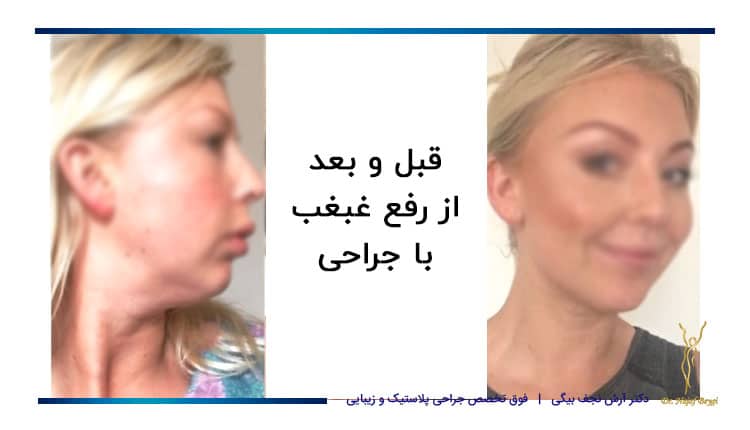 قبل و بعد از رفع غبغب با جراحی