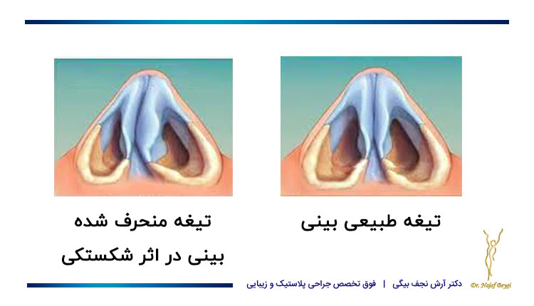 تیغه بینی منحرف شده در اثر شکستگی و تیغه طبیعی