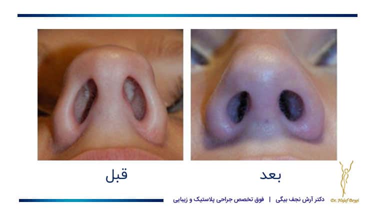 قبل و بعد از جراحی نوک بین یو جای بخیه بسیار کم