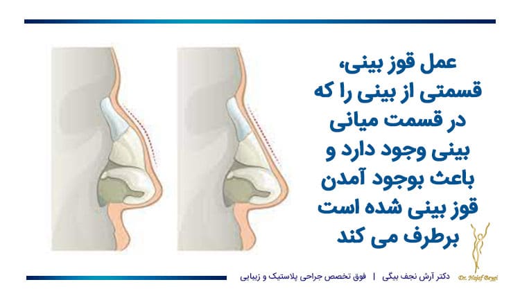 عمل قوز بینی