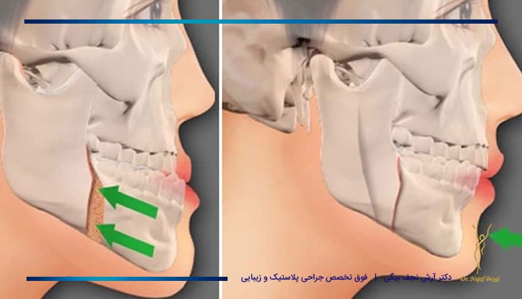 قبل و بعد عمل جراحی فک