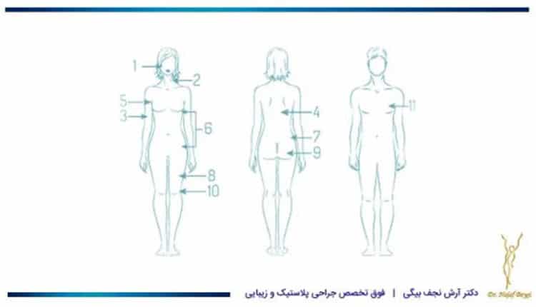 قسمت هایی از بدن که می توان برای لاغری با دستگاه اولترازد اقدام کرد