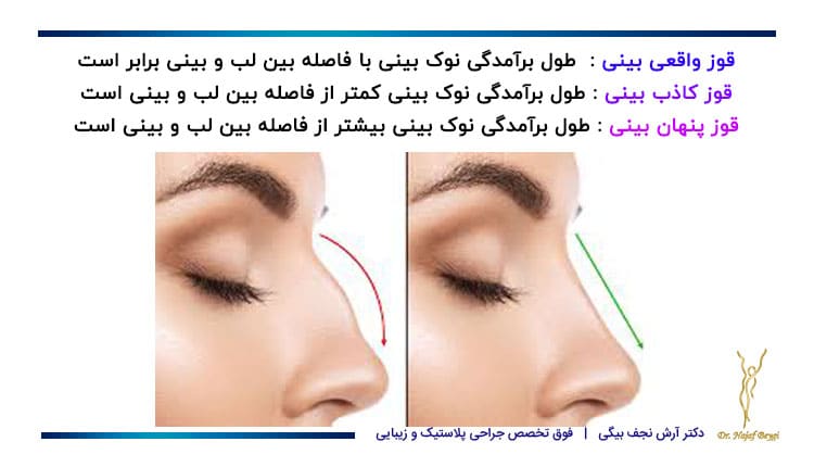 انواع قوز بینی به همراه عکس نمونه قبل و بعد از عمل قوز بینی