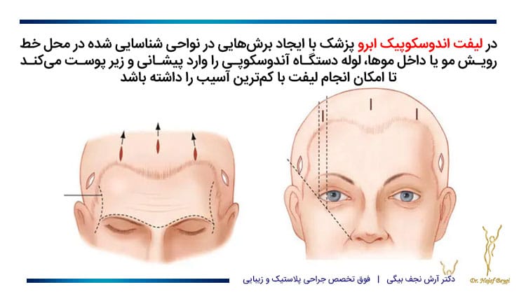 لیفت اندوسکوپیک چگونه است