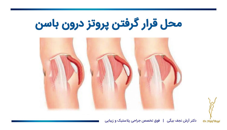 محل قرار گرفتن پروتز درون باسن