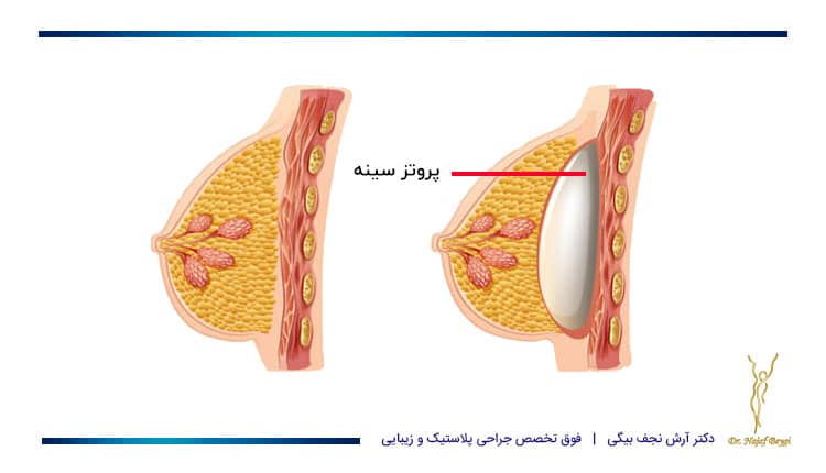 محل قرار گیری پروتز سینه