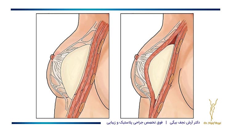 مکان کاشت پروتز سینه