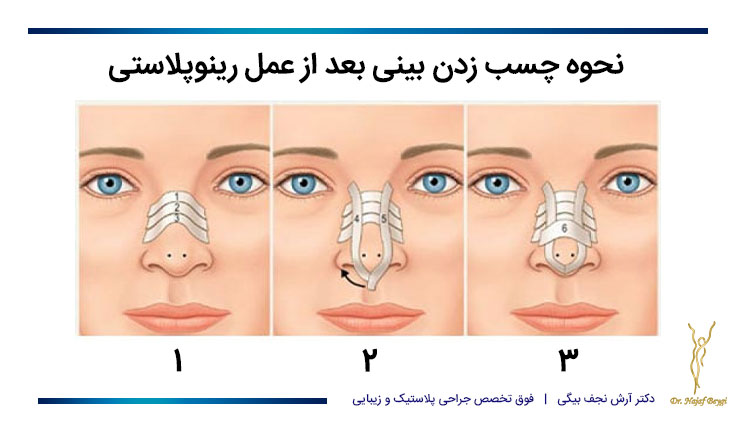 نحوه چسب زدن بینی بعد از عمل رینوپلاستی