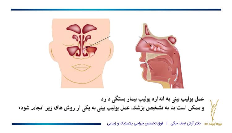 روش های عمل پولیپ بینی