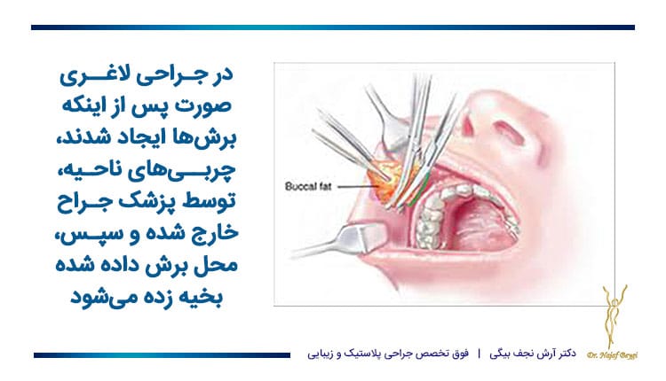 چگونگی جراحی لاغری صورت