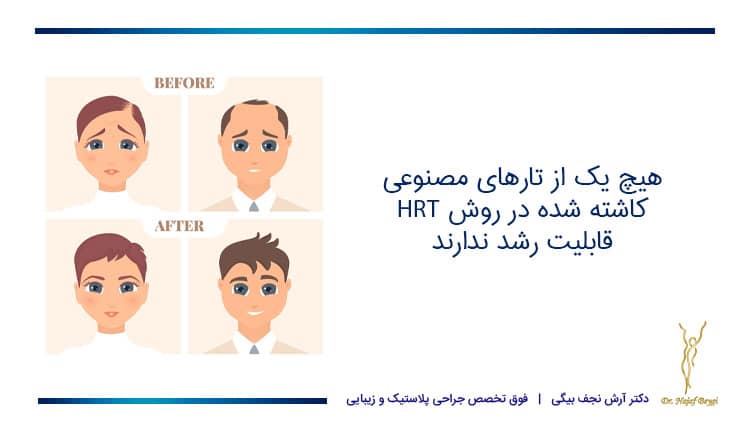 معایب کاشت مو به روش HRT