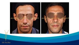 تاثیر جراحی زیبایی گوش بر شنوایی