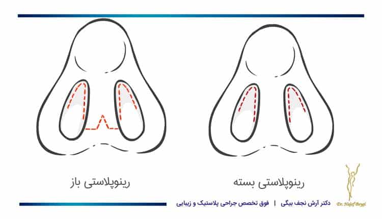 رینوپلاستی باز و بسته