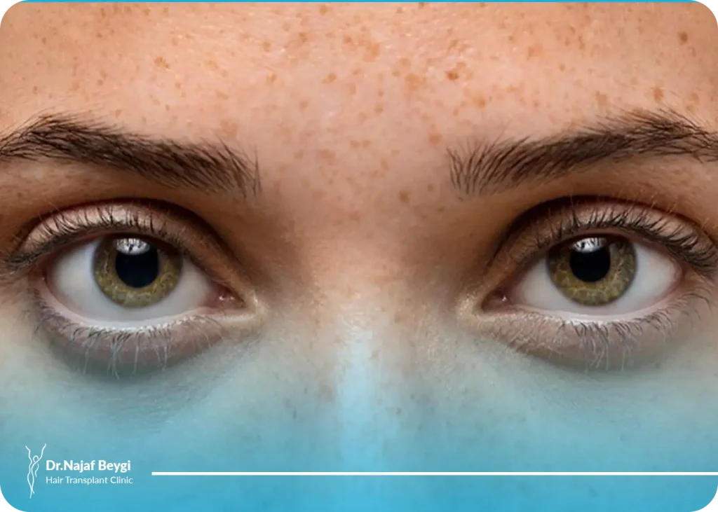 روش های درمان پف چشم