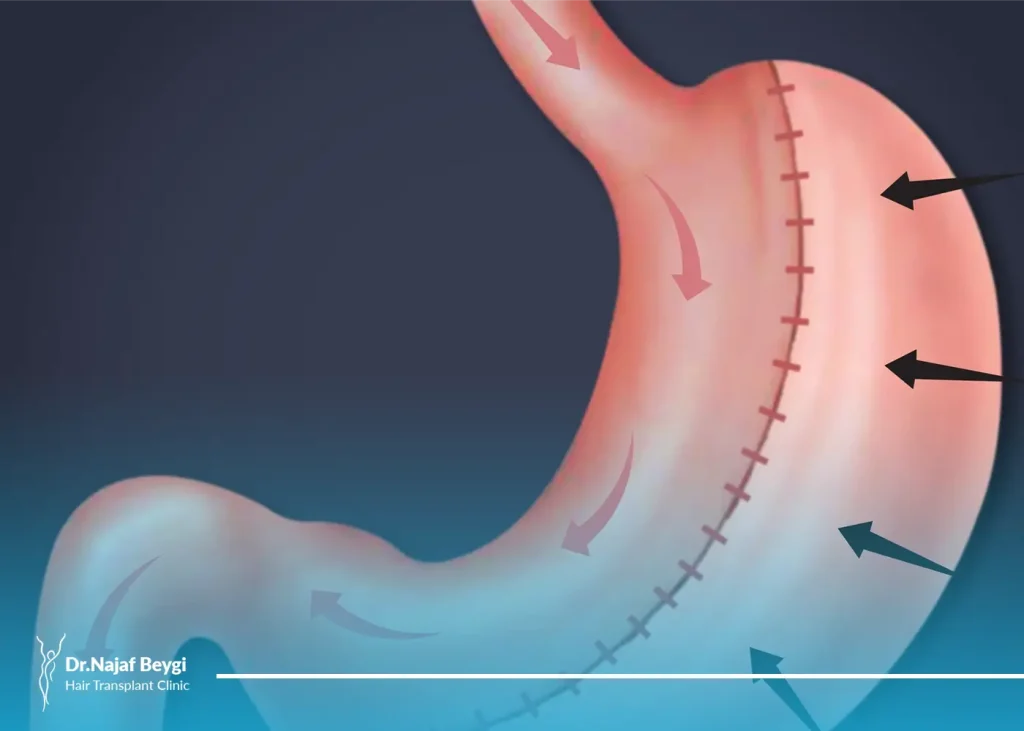 اسلیو معده بهتر است یا لیپوماتیک؟ کدام مناسب شماست؟