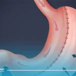 اسلیو معده بهتر است یا لیپوماتیک