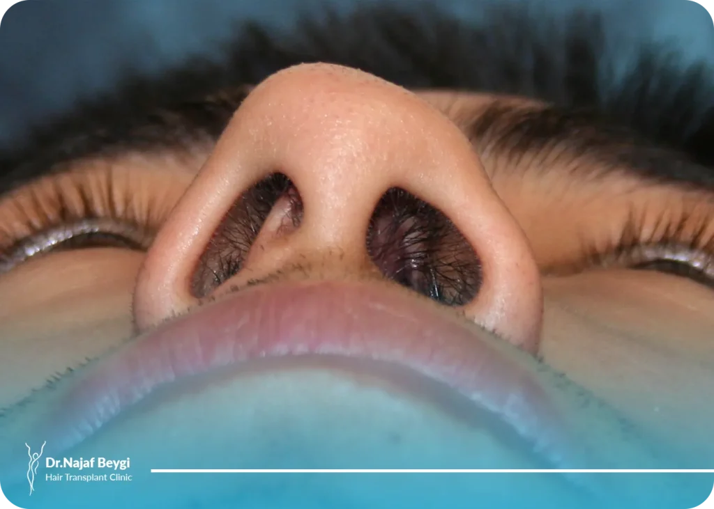 علت نا متفارن بودن سوراخ های بینی و راه های درمان و ترمیم سوراخ های بینی