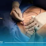 بررسی کامل تفاوت ویزر و لیپوماتیک