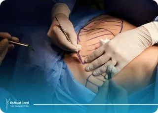 بررسی کامل تفاوت ویزر و لیپوماتیک