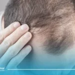 همه چیز درباره ترمیم مو HRP