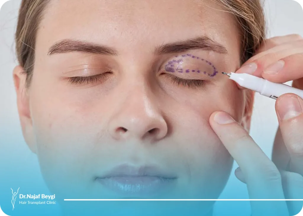 مراقبت از چشم ها بعد از عمل زیبایی پلک