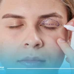 مراقبت از چشم ها بعد از عمل زیبایی پلک