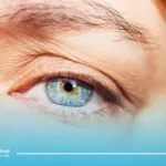 لیفت پلک؛ مراحل انجام، مزایا، معایب و هزینه