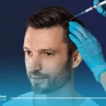 مزوتراپی مو، بهترین دارو تقویتی بعد از کاشت مو + زمان و نحوه مصرف