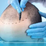 کاشت مو به روش FIT | مراحل انجام، مزایا، عوارض و مراقبت ها