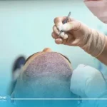 کاشت مو به روش SUT + مراحل انجام ، مزایا و معایب