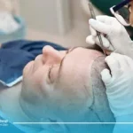 کاشت مو به روش DHI، اتفاق بزرگ بعدی در کلینیک های کاشت مو