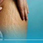 آیا رفع سلولیت با لیپوماتیک ممکن است؟