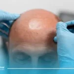 کدام فصل برای کاشت مو مناسب نیست؟