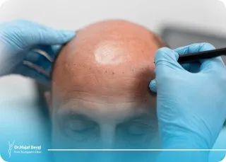 کدام فصل برای کاشت مو مناسب نیست؟