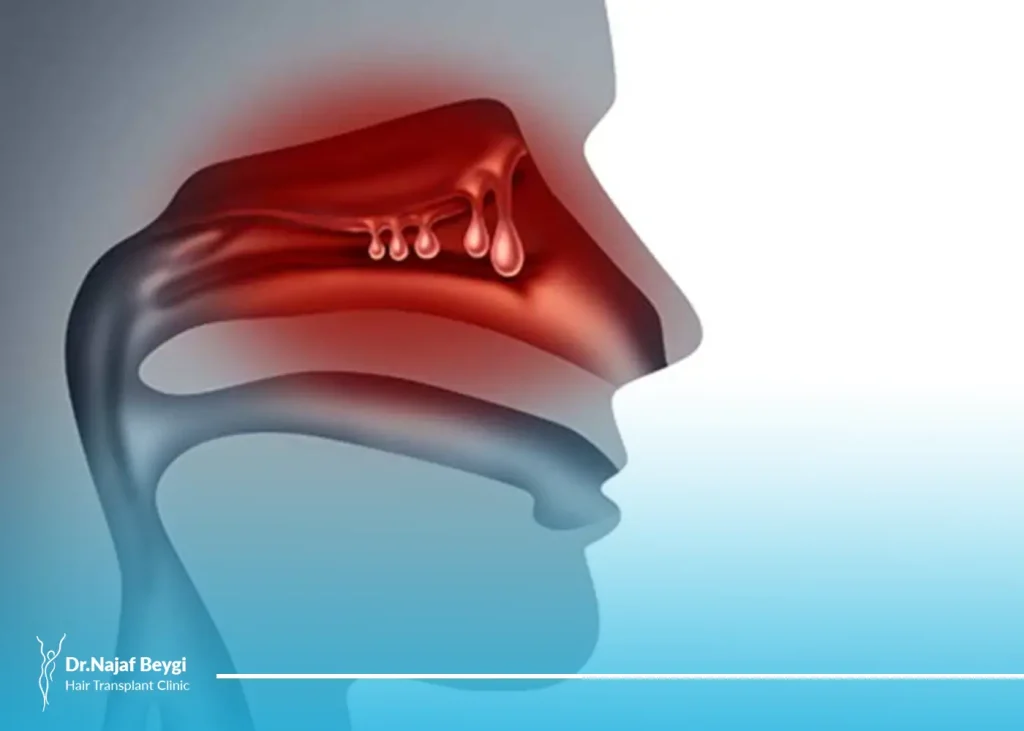 هزینه جراحی پولیپ بینی چقدر است؟