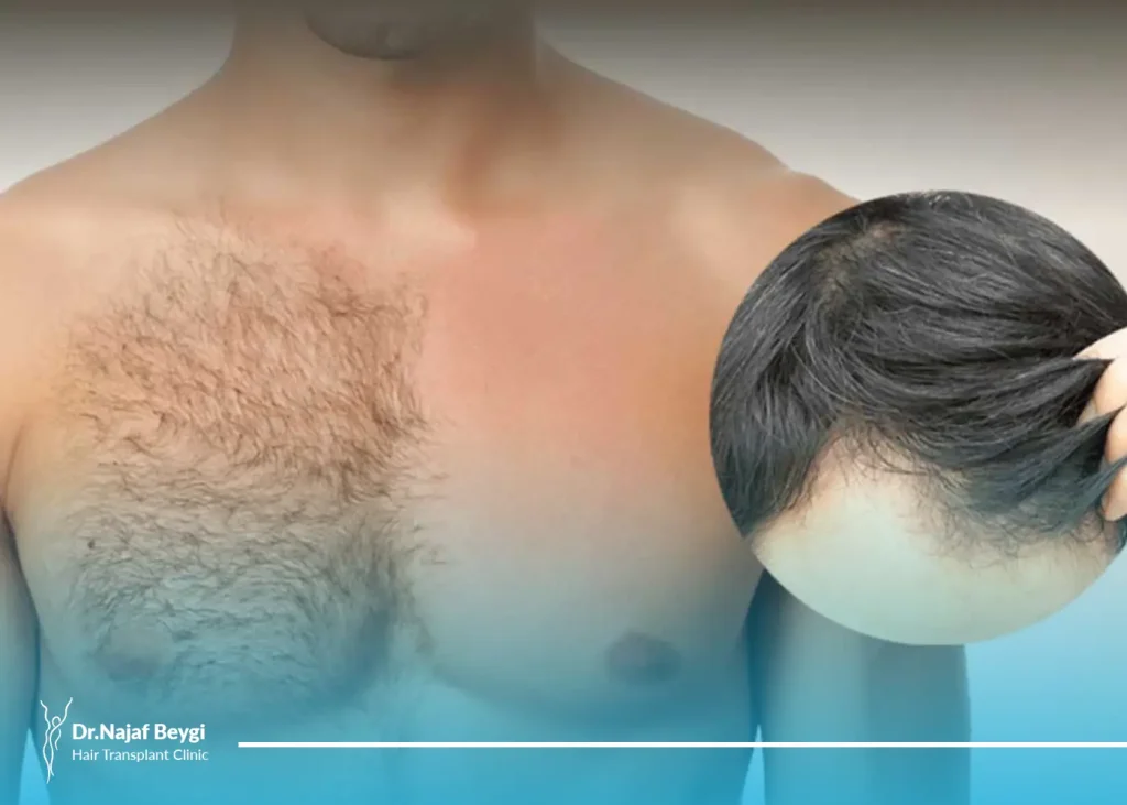 کاشت مو به روش BHT یا کاشت مو از بدن چیست؟