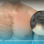 کاشت مو به روش BHT یا کاشت مو از بدن