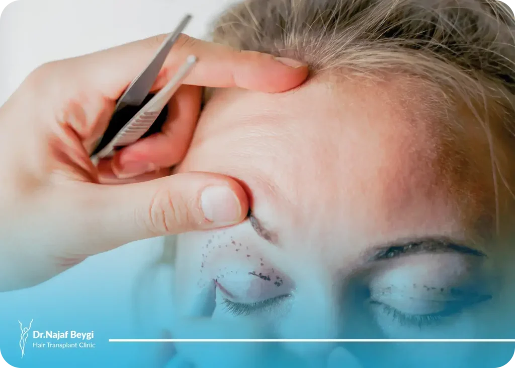 عمل افتادگی پلک یا درمان افتادگی پلک چگونه انجام می‌شود؟