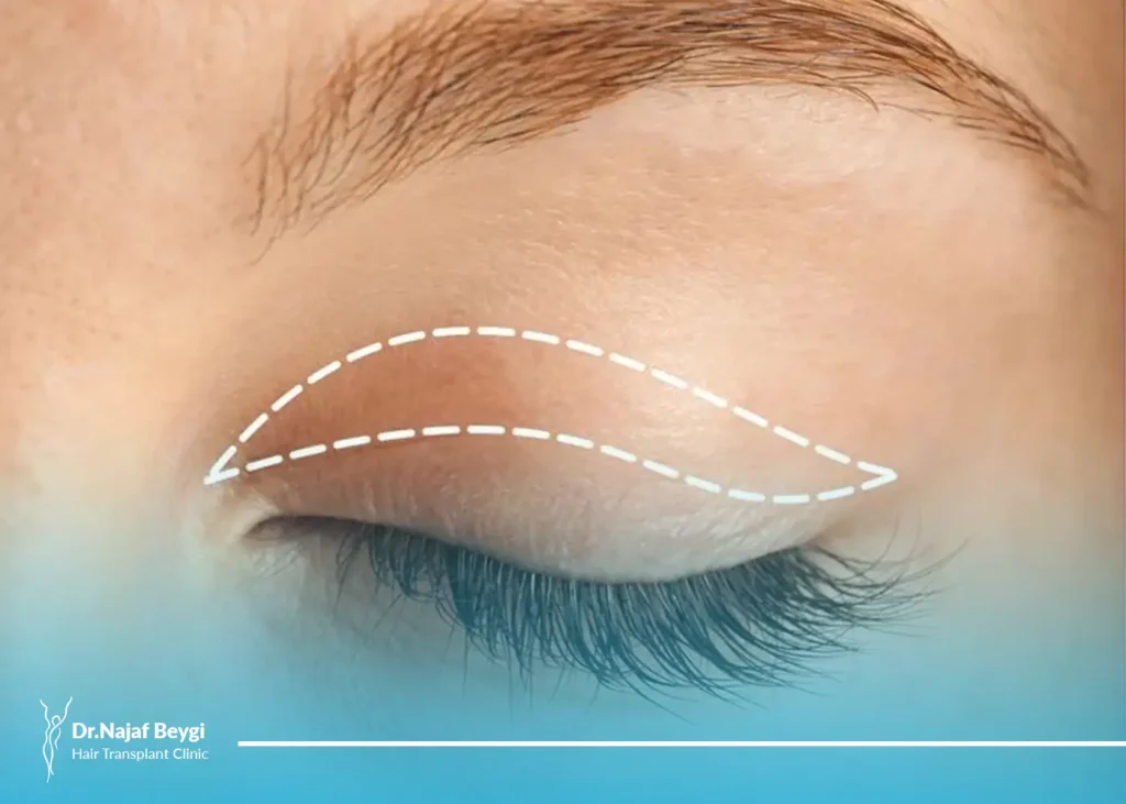 همه چیز درباره جراحی پلک با بی حسی