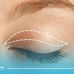 جراحی پلک با بی حسی