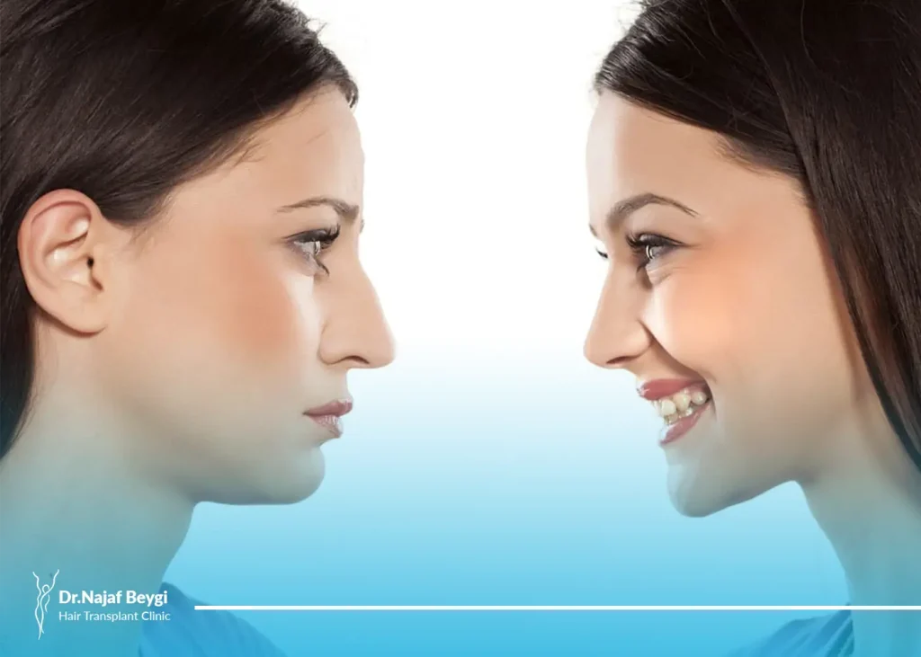 هزینه ی رینوپلاستی (جراحی زیبایی بینی) و عوامل و فاکتور های تاثیر گذار برآن