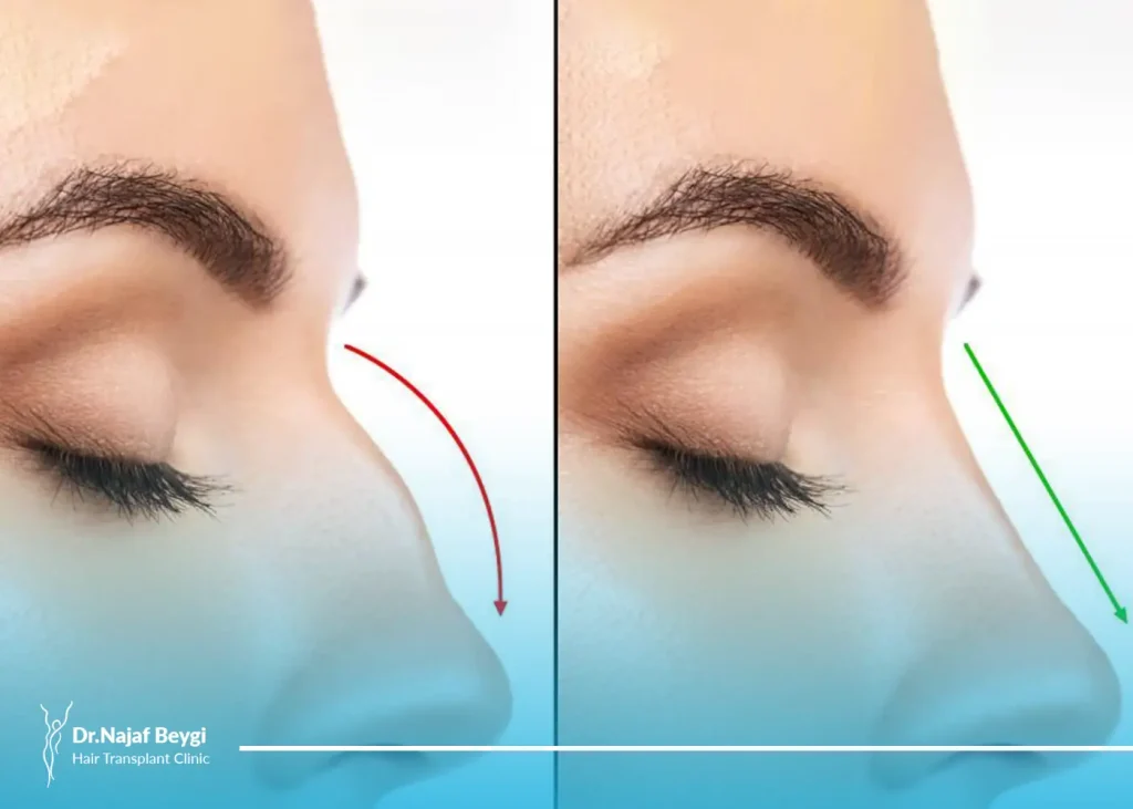 همه چیز در مورد جای بخیه ‌ها بعد از عمل بینی