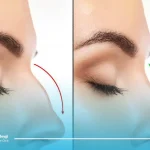بخیه بعد از عمل بینی