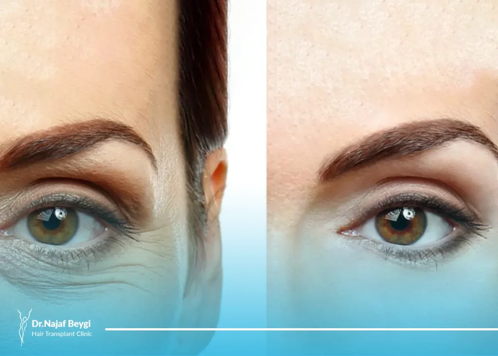 جوانسازی اطراف چشم